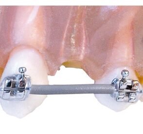 Archwire sleeve protective tubing