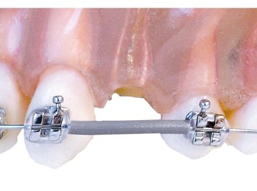 Archwire sleeve protective tubing